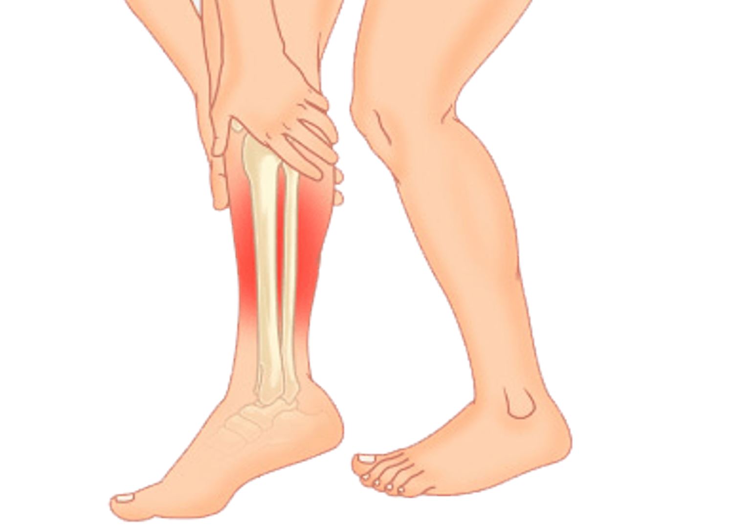 Shin Splints